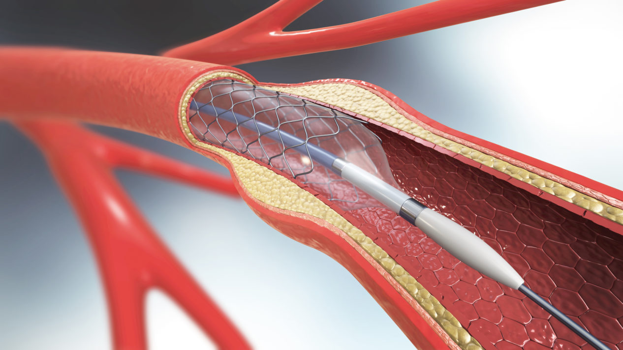 Meine Op Stent Implantation Im Gef Im Halsbereich Klinikguide At